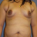 Mommy Makeover Before & After Patient #1971