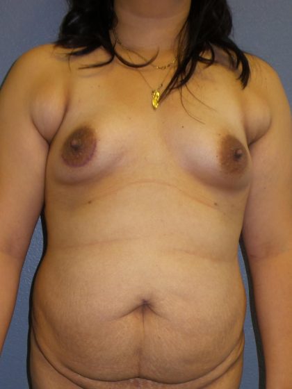 Mommy Makeover Before & After Patient #1971