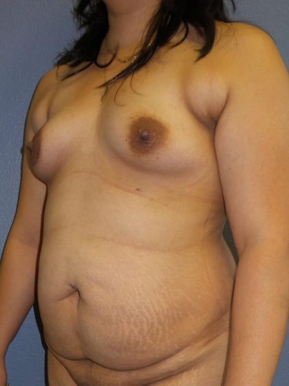 Mommy Makeover Before & After Patient #1971