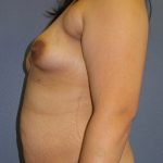 Mommy Makeover Before & After Patient #1971