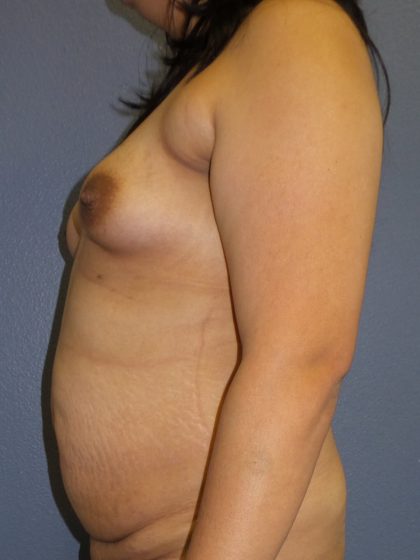 Mommy Makeover Before & After Patient #1971