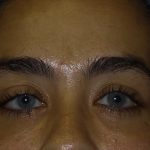 Blepharoplasty Before & After Patient #1275