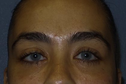 Blepharoplasty Before & After Patient #1275