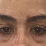 Blepharoplasty Before & After Patient #1275