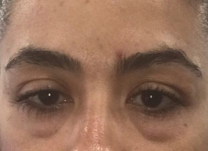 Blepharoplasty Before & After Patient #1275