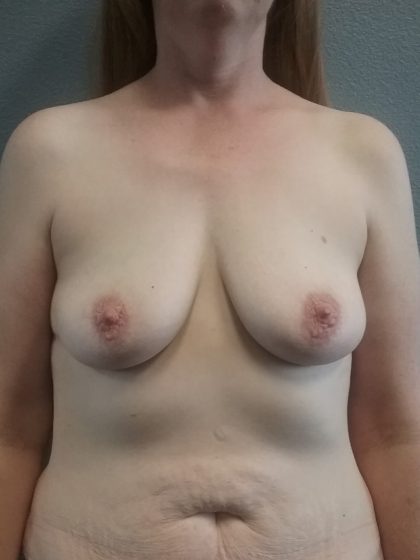Breast Augmentation Before & After Patient #1542
