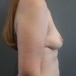 Breast Augmentation Before & After Patient #1542