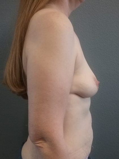 Breast Augmentation Before & After Patient #1542