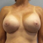 Breast Augmentation Before & After Patient #1568