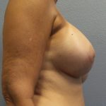 Breast Augmentation Before & After Patient #1568