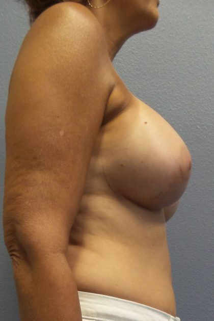 Breast Augmentation Before & After Patient #1568