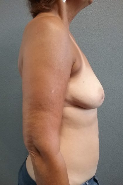 Breast Augmentation Before & After Patient #1568