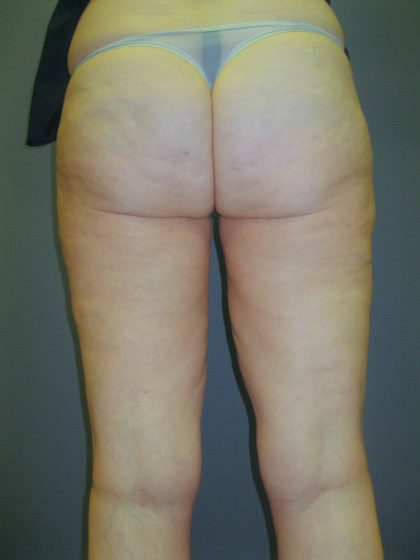 Liposuction Female Before & After Patient #1091