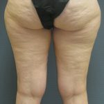 Liposuction Female Before & After Patient #1091