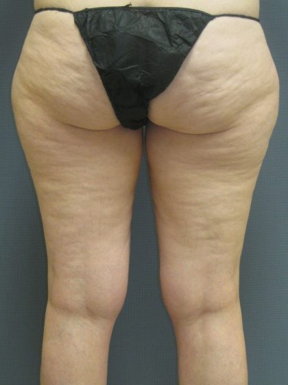 Liposuction Female Before & After Patient #1091