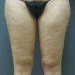 Liposuction Female Before & After Patient #1091