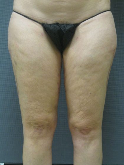 Liposuction Female Before & After Patient #1091