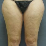 Liposuction Female Before & After Patient #1091
