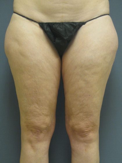 Liposuction Female Before & After Patient #1091