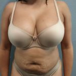 Liposuction Female Before & After Patient #1191