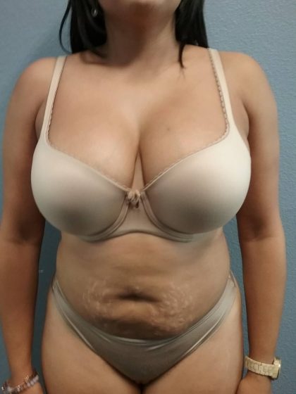 Liposuction Female Before & After Patient #1191