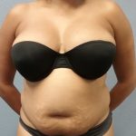 Liposuction Female Before & After Patient #1191