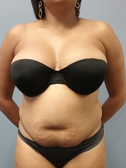Liposuction Female Before & After Patient #1191