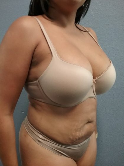 Liposuction Female Before & After Patient #1191