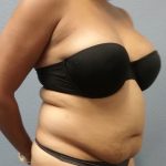 Liposuction Female Before & After Patient #1191