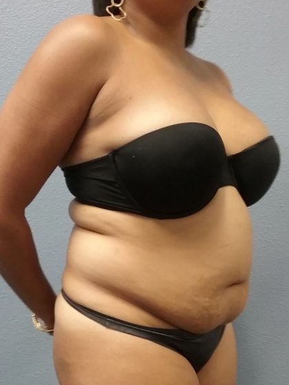 Liposuction Female Before & After Patient #1191