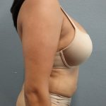 Liposuction Female Before & After Patient #1191