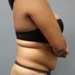 Liposuction Female Before & After Patient #1191