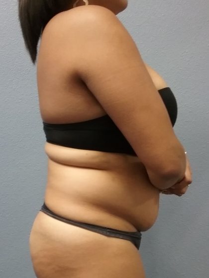 Liposuction Female Before & After Patient #1191