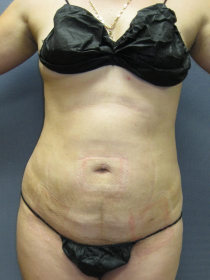 Liposuction Female Before & After Patient #1212