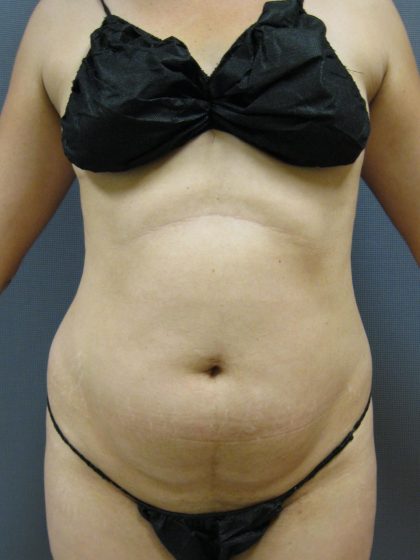 Liposuction Female Before & After Patient #1212