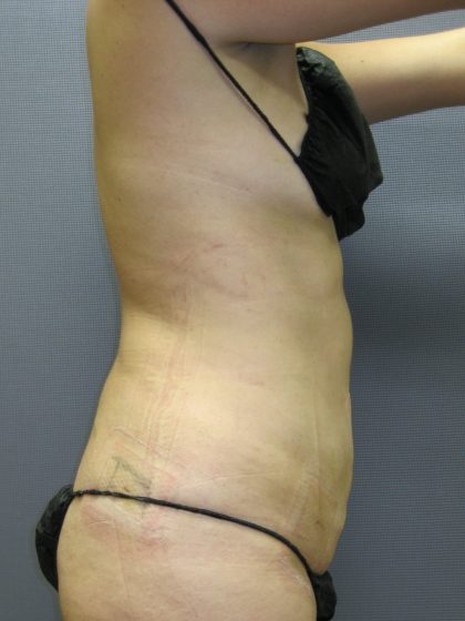 Liposuction Female Before & After Patient #1212