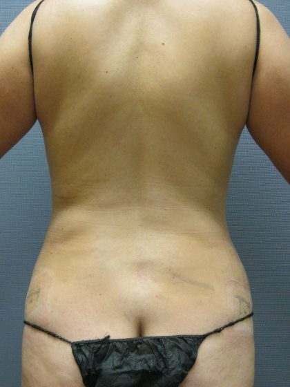 Liposuction Female Before & After Patient #1212