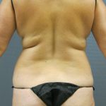Liposuction Female Before & After Patient #1055