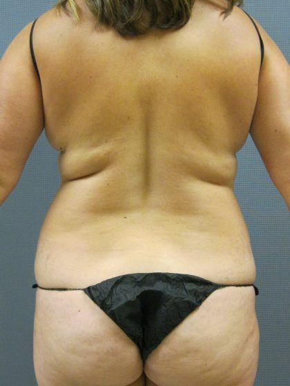 Liposuction Female Before & After Patient #1055