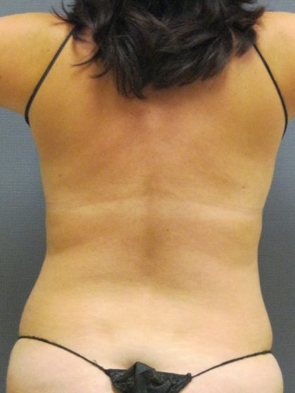 Liposuction Female Before & After Patient #1079