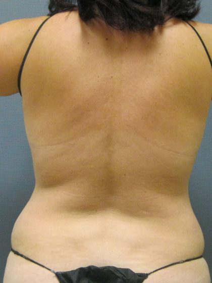 Liposuction Female Before & After Patient #1079