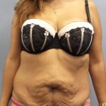 Abdominoplasty Before & After Patient #2127