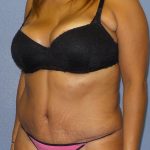 Abdominoplasty Before & After Patient #2127
