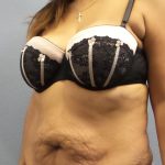Abdominoplasty Before & After Patient #2127