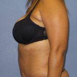Abdominoplasty Before & After Patient #2127