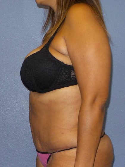 Abdominoplasty Before & After Patient #2127