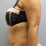 Abdominoplasty Before & After Patient #2127