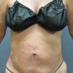 Liposuction Female Before & After Patient #1184