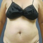 Liposuction Female Before & After Patient #1184