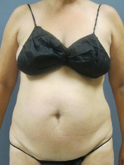 Liposuction Female Before & After Patient #1184